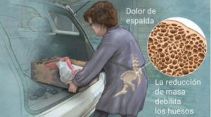 Osteoporosis Dolor de espalda
