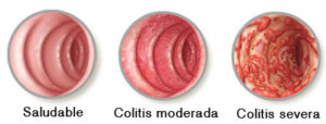 Colitis Normal - Moderada - Severa