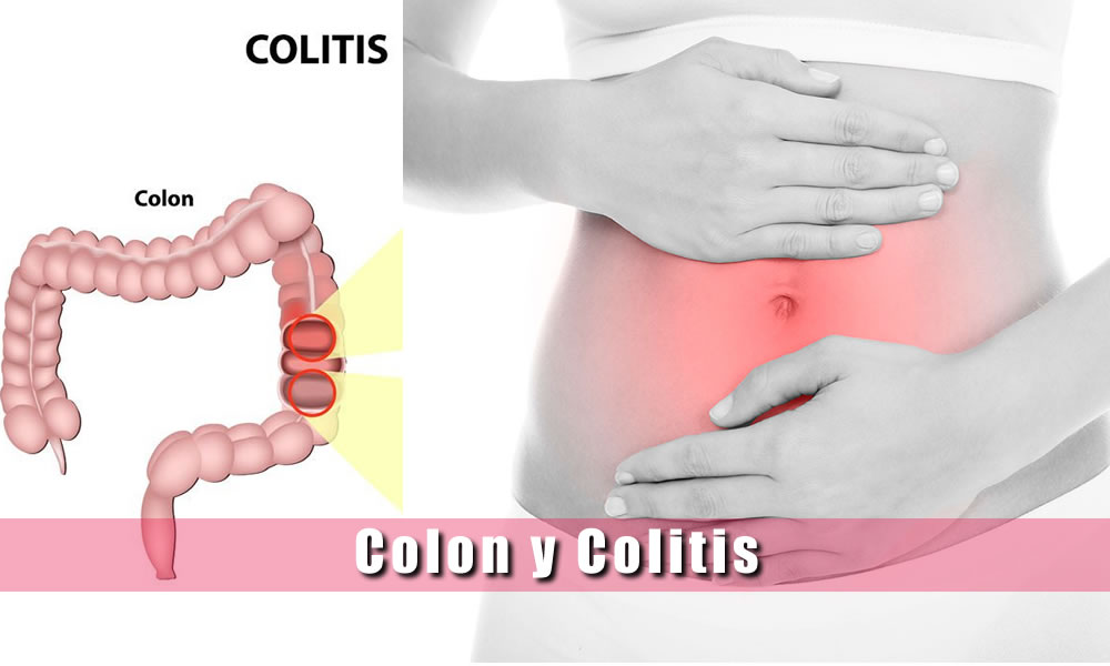 colon y colitis sintomas causas tratamiento