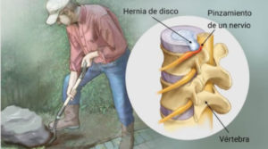 hernia discal dolor de espalda