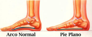 pie plano - enfermedades de los pies
