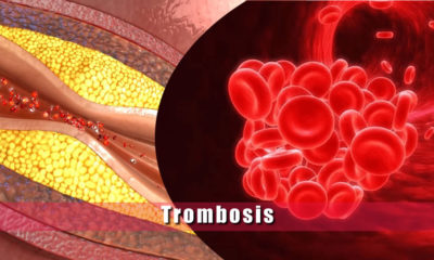 trombosis causas sintomas y tratamiento de la trombosis
